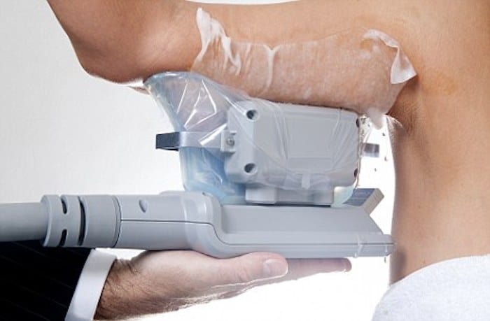 fat freezing arms Stoke