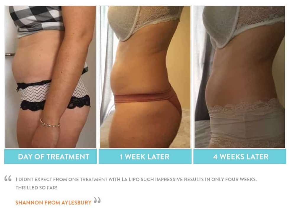 before, Cryolipolysis Stoke