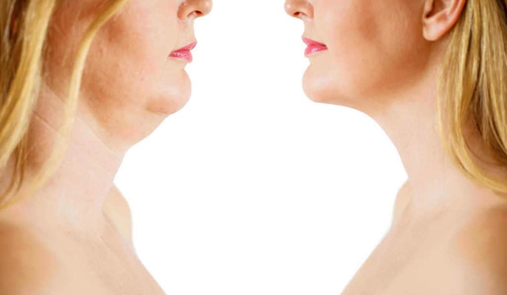 Double Chin treatment Stoke before and after results