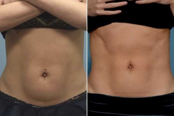 body sculpting FAQs Stoke