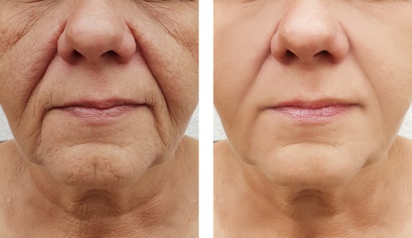 Learn more about Morpheus8 Treatment Stoke today!