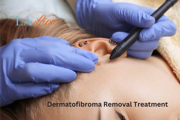 Dermatofibroma Removal Treatment Stoke