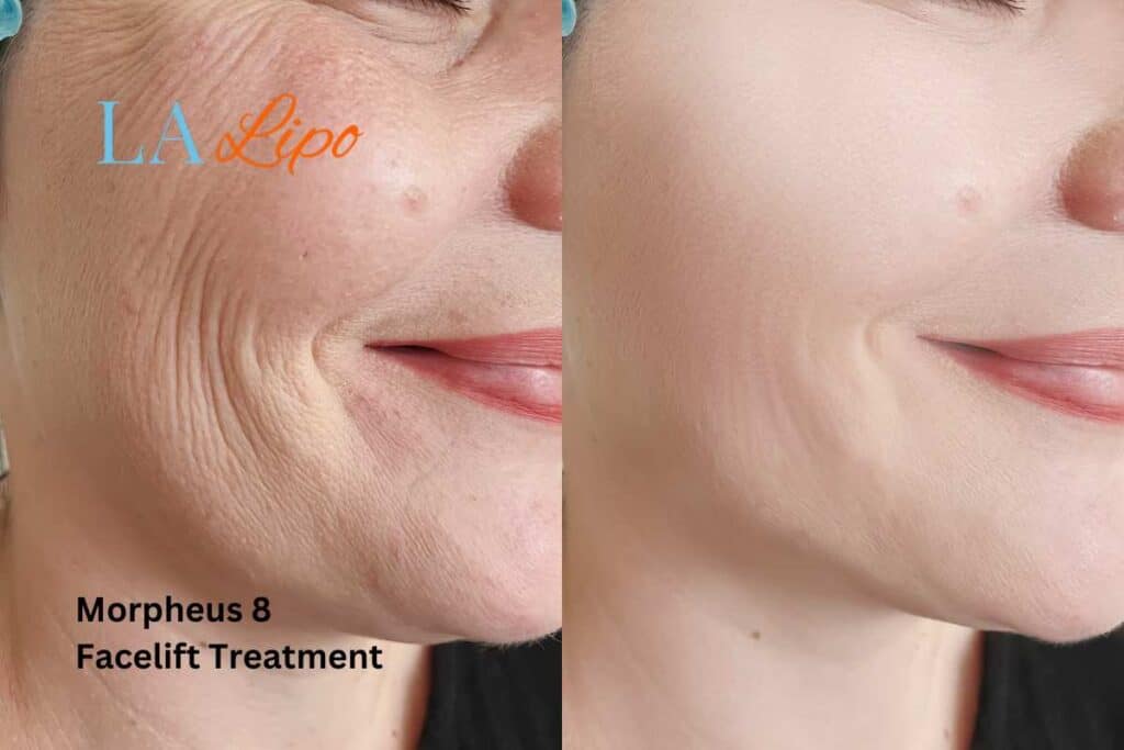 Morpheus8 Treatment Stoke for flawless skin! Call us today!