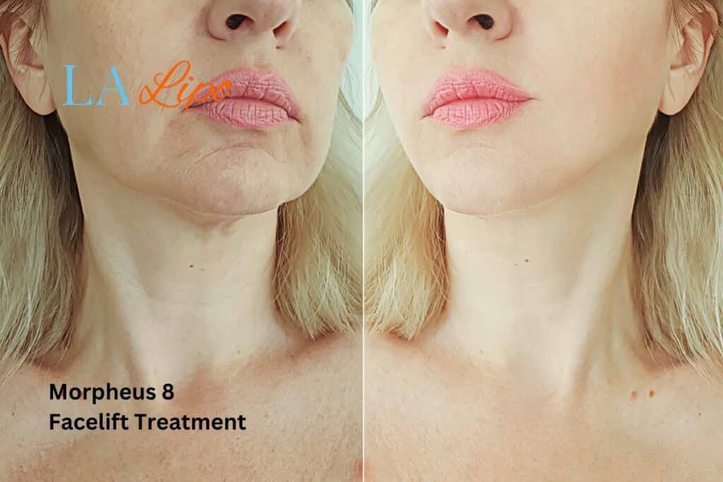 Turn back time with Morpheus8 Treatment Stoke