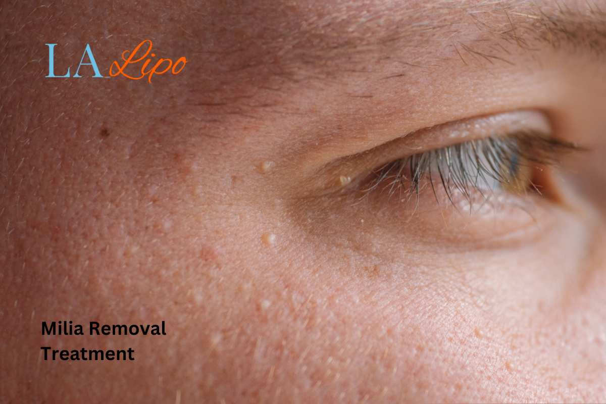Cryopen Milia Removal: Is It the Easiest and Safest Option Stoke?