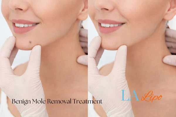 Before-and-after results following benign mole-removal treatment Stoke