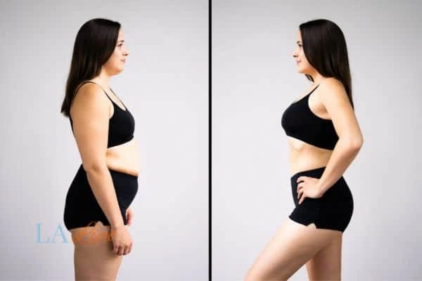 image of woman before and after results of LA-EMS Body Sculpting Stoke to help treat Diastasis recti