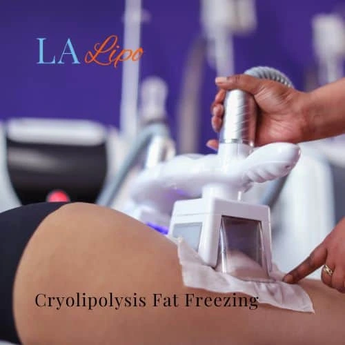 fat freezing - Cryolipolysis Stoke