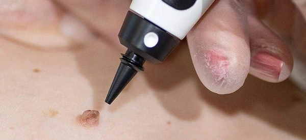 skin tag removal using cryopen Stoke