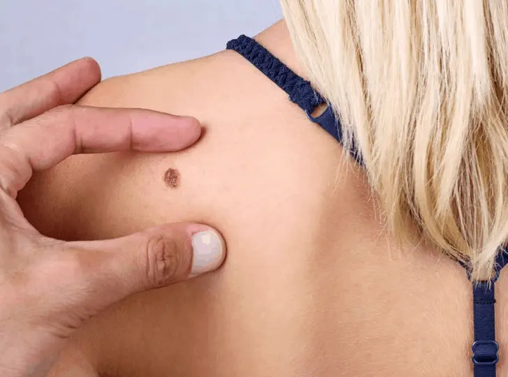 woman having mole removal Stoke consultation before treatment.