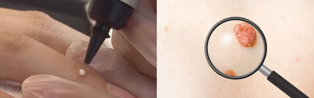 Cryopen for mole removal Stoke - speak to our team today!