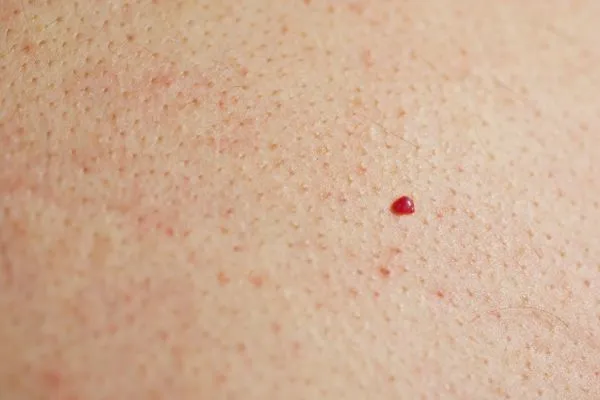close up of a cherry angioma Stoke