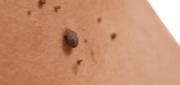 image of a skin tag Stoke