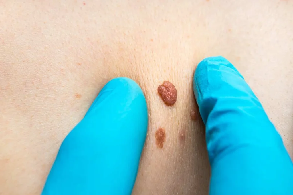 Consultant examining a skin tag Stoke
