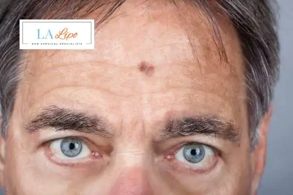 Solar Lentigo Removal Stoke image of man with mark on his forehead