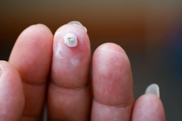wart on person finger - cryotherapy to treat from LA LIPO Stoke