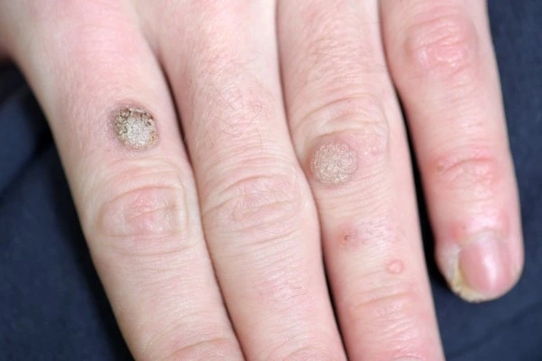 photo of warts on person hand - see wart removal Stoke from LA LIPO