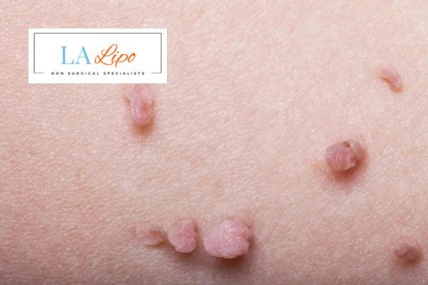 Does cryopen skin tag removal Stoke hurt? Find out now call our team today!