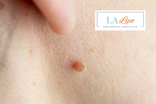 Book skin tag removal Stoke today speak to our team now!