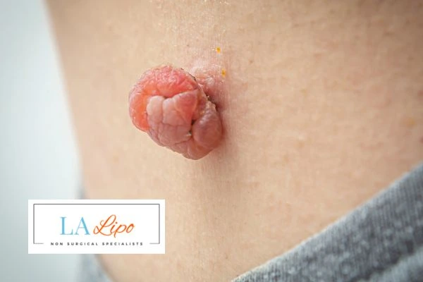 Interested in skin tag removal Stoke? Concerned about the pain? Find out more today!