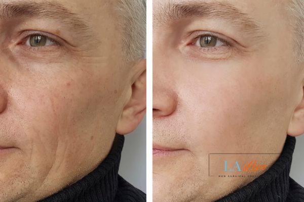 See the amazing results of Morpheus8 Treatment Stoke!