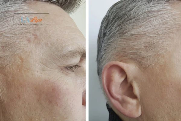 Mens Before & After Morpheus 8 Results Stoke