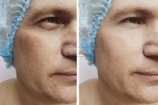 Before and after Morpheus 8 Results Stoke