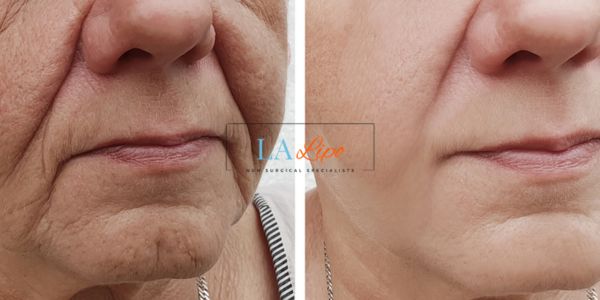Older lady deeper wrinkle reduction - LA LIPO Morpheus 8 Results Stoke