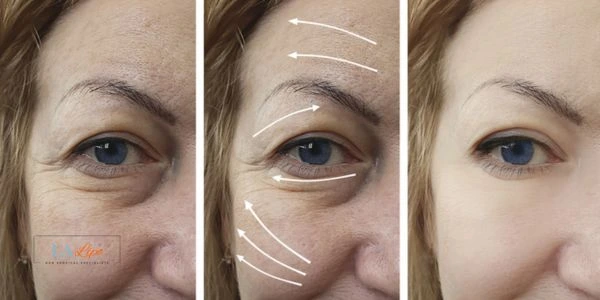 Amazing eye lift Morpheus 8 results Stoke