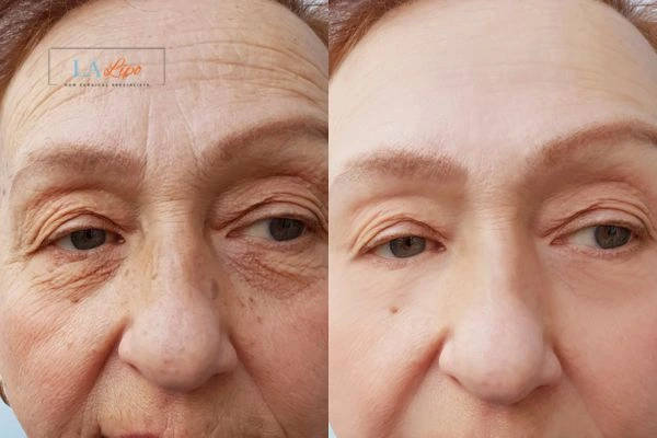 The powerful benefits of Morpheus8 Treatment Stoke - Call Our team today!