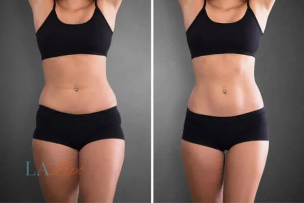 before and after results of non-surgical treatment to help a woman's body image and mental health Stoke