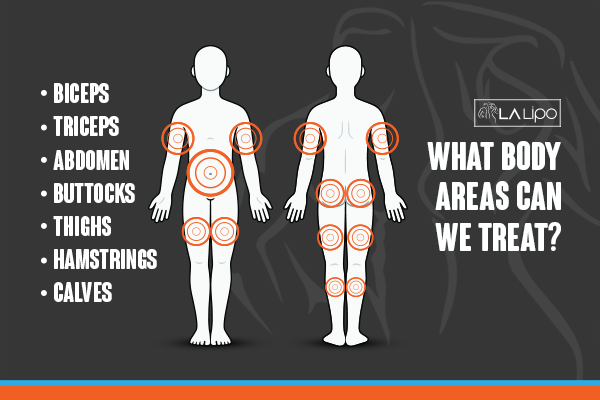 Diagram to show areas you can have LA-EMS Body Sculpting Treatment Stoke