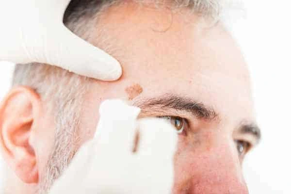 Age spots and elderly people Stoke what is the link?