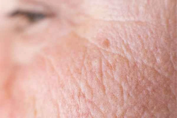 close up picture of a woman's face showing an age spot Stoke