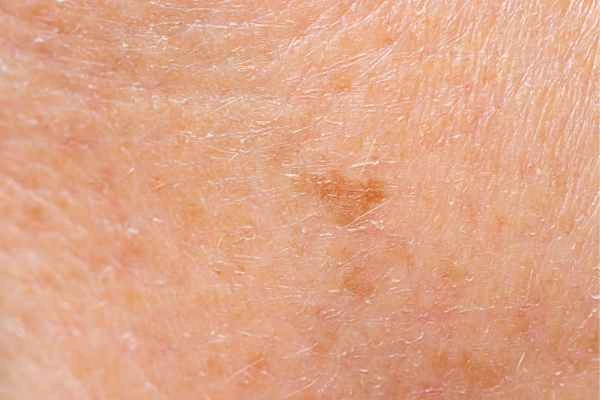 close up picture of age spots Stoke
