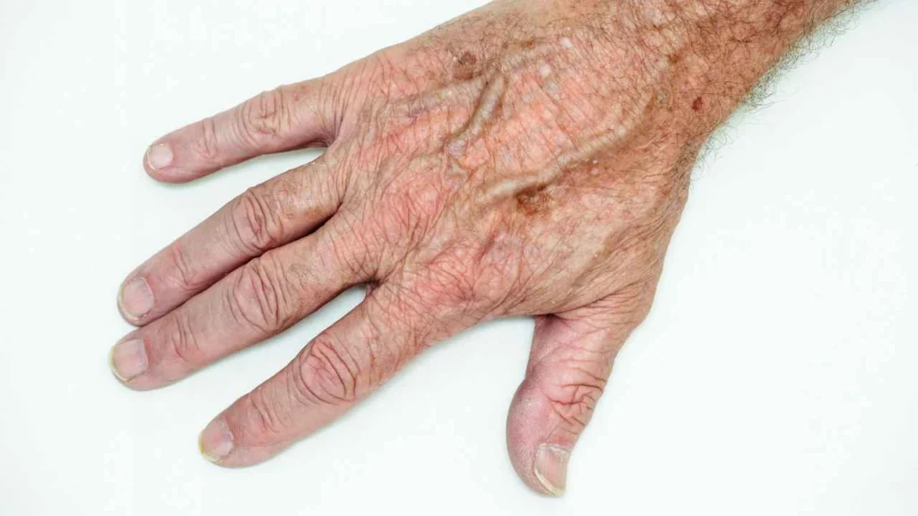 Male hand showing age spot Stoke