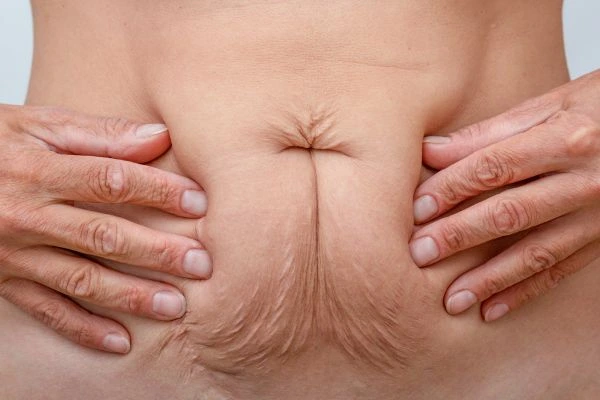 Image of a woman's stomach with loose skin - example of skin tightening Stoke options