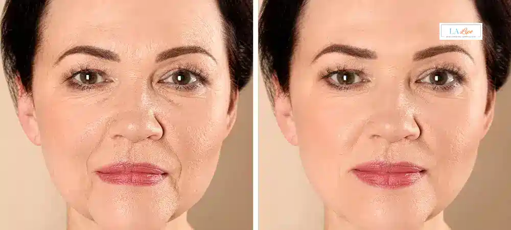 How Long Does It Take to See Results and How Long Do They Last Stoke?