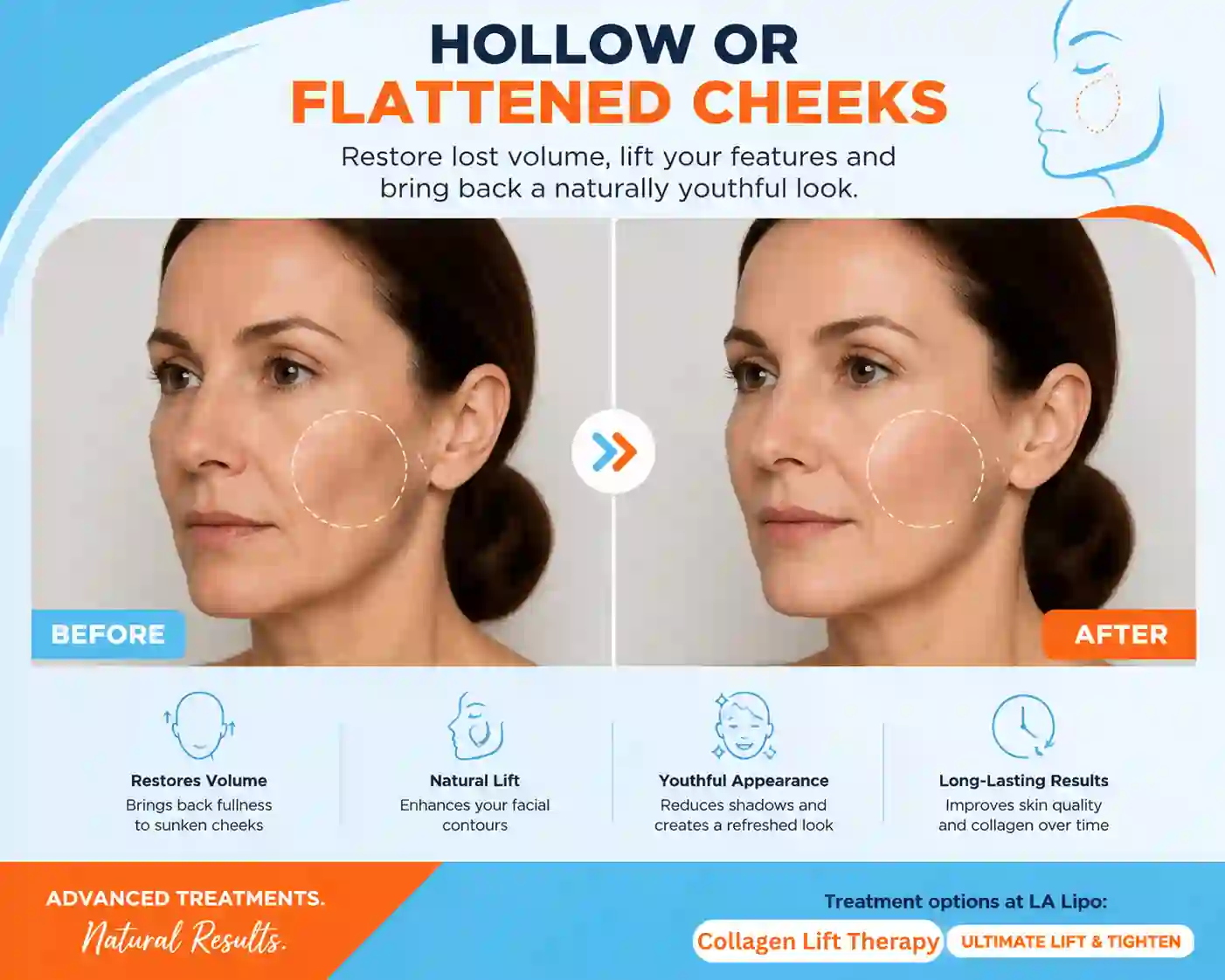 Sign #4: Hollow or Flattened Cheeks Stoke