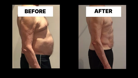 What Symptoms Can Diastasis Recti Cause in Men? Weak Core, Back Pain and Poor Posture Stoke